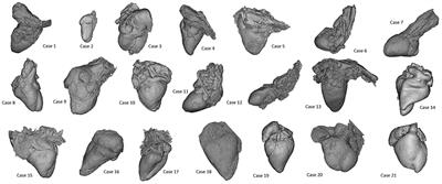 Three-Dimensional Printing of Fetal Models of Congenital Heart Disease Derived From Microfocus Computed Tomography: A Case Series